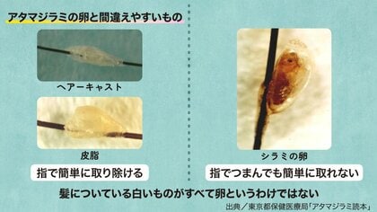 ケジラミ 卵 毛じらみの卵の特徴 ふ化するまでの時間 シャンプーが効かない事などについて 人気