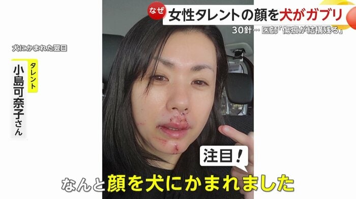 犬にかまれた翌日の小島可奈子さん