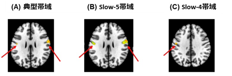 社交不安症患者の脳活動に新発見～感覚処理領域の活動低下が認知機能障害と関連～