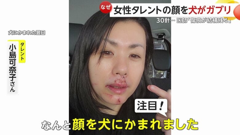 犬にかまれた翌日の小島可奈子さん