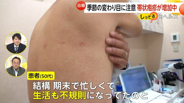 「生活も不規則になっていた」と話す帯状疱疹で受診した患者