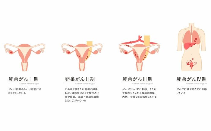 卵巣がんのステージによる状態