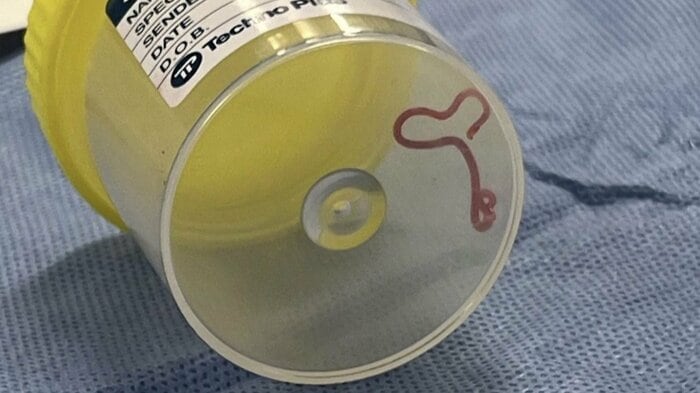 寄生虫の長さは8cm