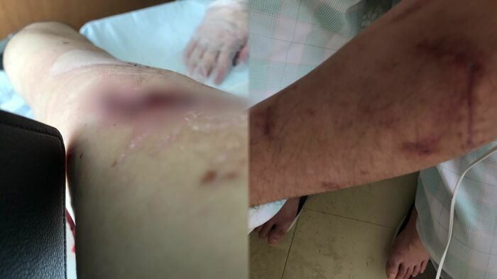 肺に穴が開いたほか、全身で140針を縫う大けがを負った安藤さん