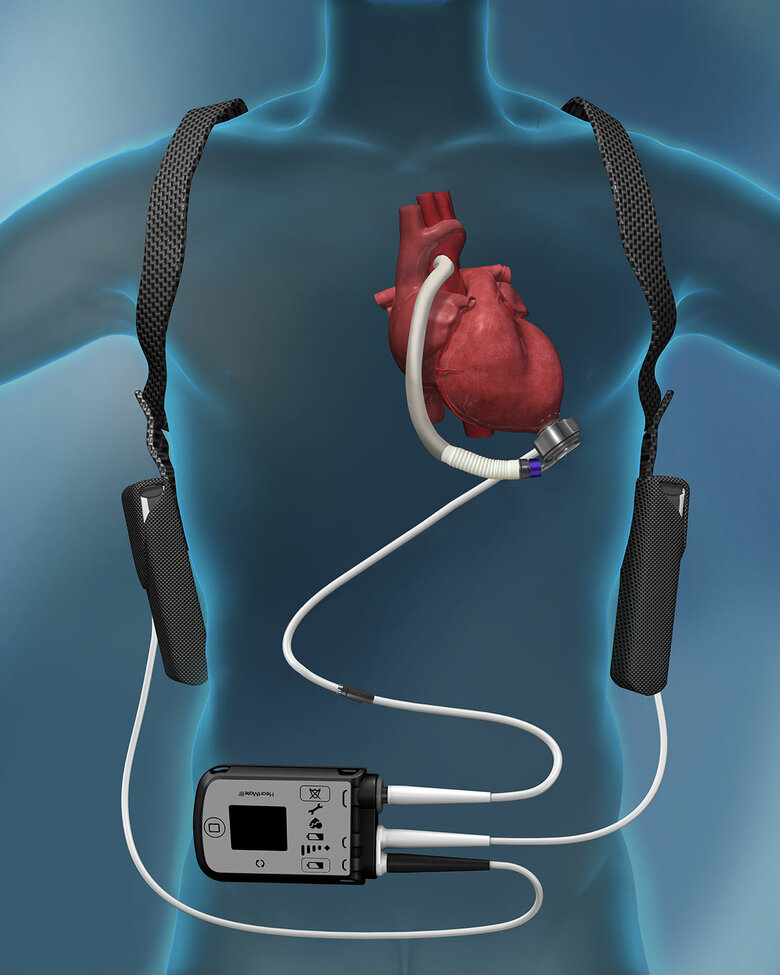 難治性心不全を救う！植込型左室補助人工心臓（LVAD）の最新治療報告会