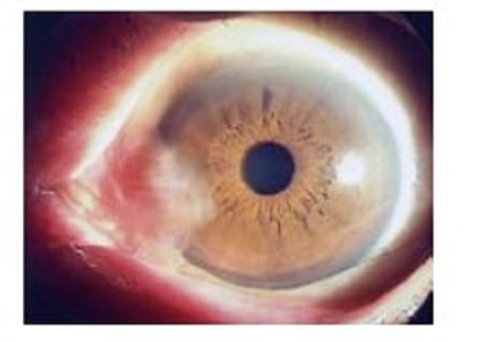 （翼状片・左目、環境省HPより）