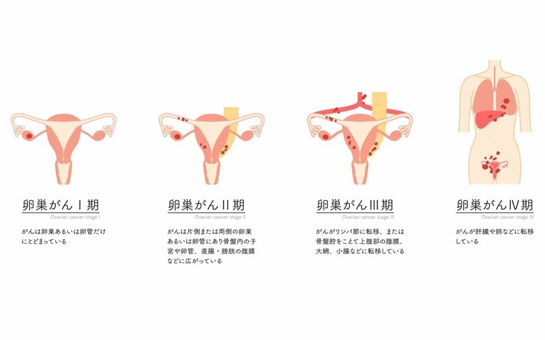 卵巣がんのステージによる状態