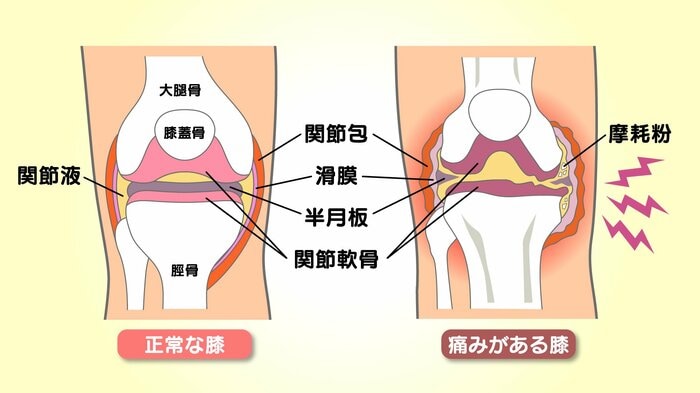 「正常な膝」と「痛みがある膝」