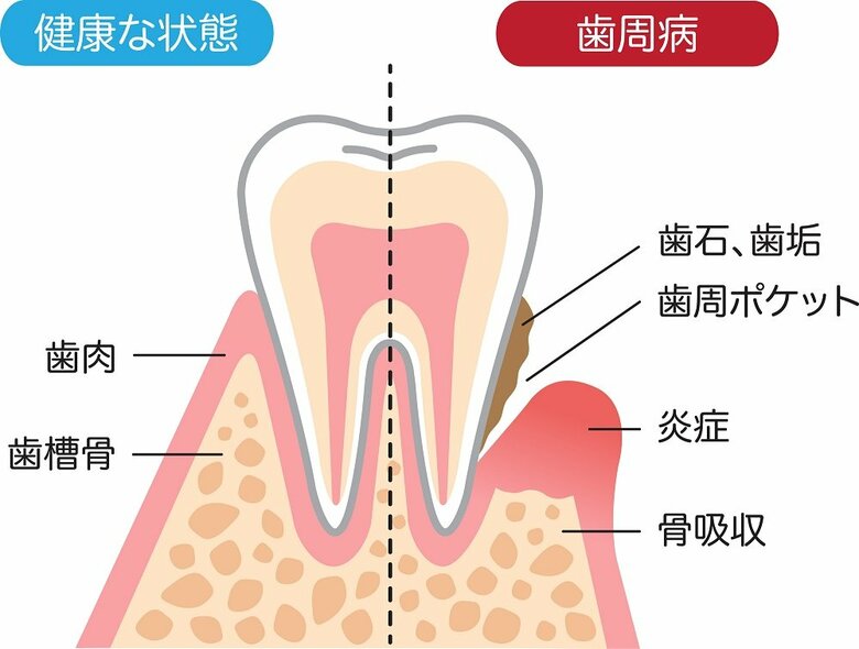 ※歯周ポケットイメージ