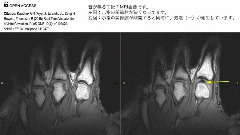 音が鳴る前後のMRI画像（提供：平泉裕）