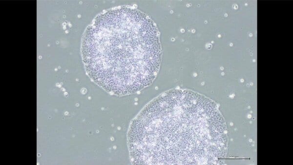 Japan: Kyoto University Hospital performs first iPS cell transplant for Parkinson's disease
