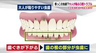 大人が陥る口腔トラブル　歯の根っこの虫歯　健康な歯を守るため定期的にメンテナンスを
