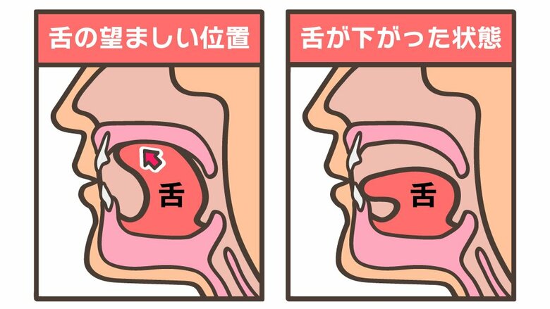 舌の望ましい位置、下がった状態（イラスト：さいとうひさし）