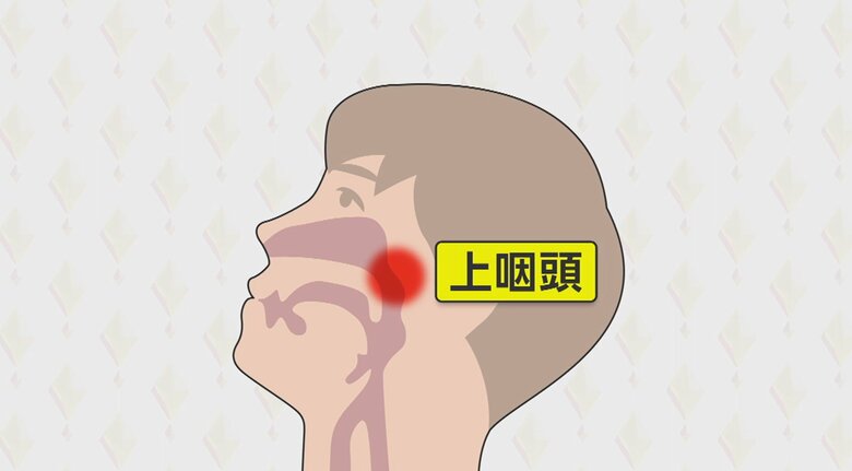 頭痛や痰などコロナ後遺症に有効な「上咽頭擦過療法」約2か月で症状軽減も！さらに医師のお勧めは“鼻うがい”｜FNNプライムオンライン