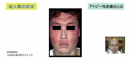 しつこくぶり返すアトピー性皮膚炎も治る時代へ 汗や紫外線、コロナストレスも悪化要因に 最新“プロアクティブ療法”を医師が解説