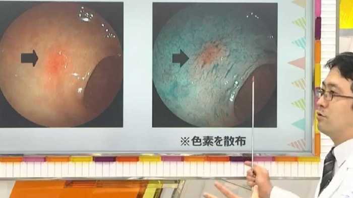 「苦しくない」=「良い医師」ではない?!がん検診の胃カメラ&大腸内視鏡
