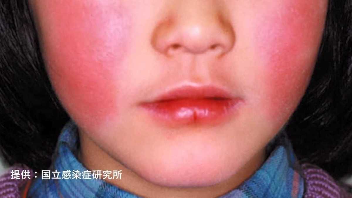 赤い頬が出る頃にはもう遅い 患者急増の リンゴ病 気づかず感染に要注意