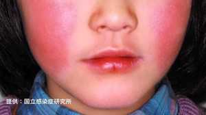 赤い頬が出る頃にはもう遅い!患者急増の “リンゴ病” 気づかず感染に要注意