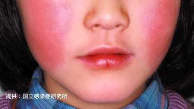 赤い頬が出る頃にはもう遅い!患者急増の “リンゴ病” 気づかず感染に要注意