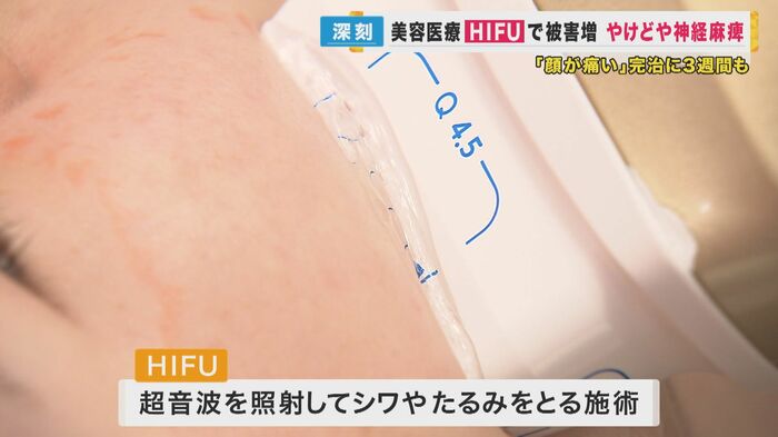 超音波を照射してシワやたるみをとる施術
