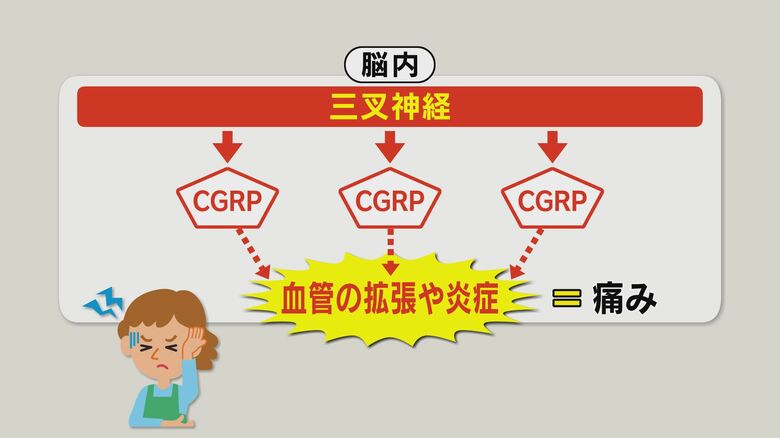 片頭痛の仕組み