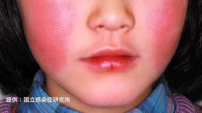 赤い頬が出る頃にはもう遅い!患者急増の “リンゴ病” 気づかず感染に要注意