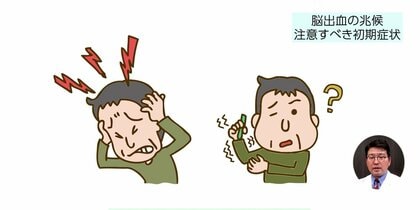 「脳出血」の主な原因は高血圧…“歯周病”との関係も最近注目　初期症状や予防法を専門医が解説