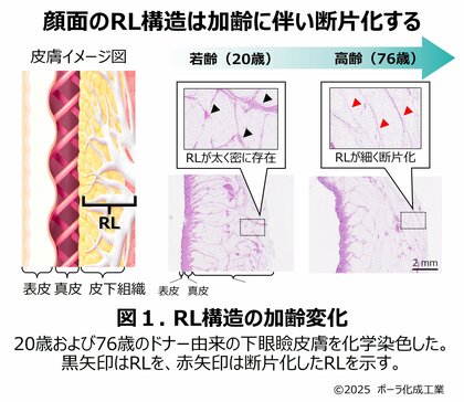 皮下深部の「Retaining Ligament(RL)」がたるみと関連