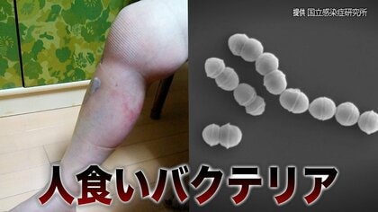 【致死率3割】“人食いバクテリア”感染過去最多に　8年前に感染し右脚を失った女性語る恐怖「最初はただの打撲だと…」