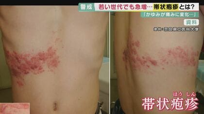 「“かゆみ”から ビリビリした痛み」若い世代でも急増「帯状疱疹」治療が遅れ重症化も 予防のポイント は“ノンストレス”【大阪発】 