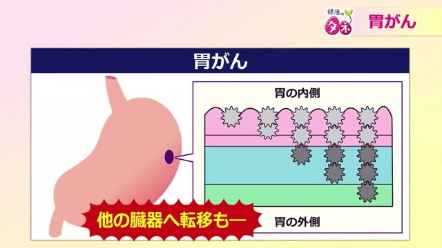 胃がんが進行するメカニズム