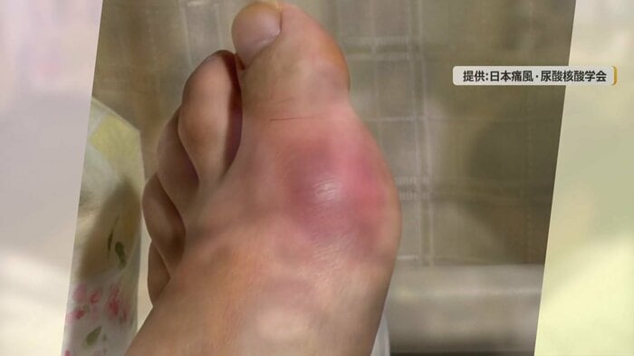 痛風の発作で赤く腫れた患部