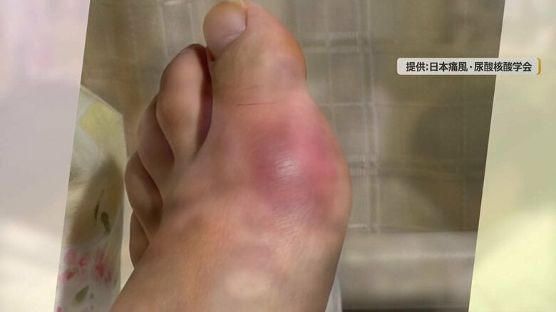 痛風の発作で赤く腫れた患部