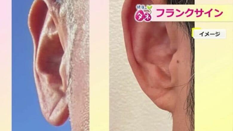耳たぶの深いシワ…心疾患を示す「フランクサイン」かも　見つけたら生活習慣の見直しを　｜FNNプライムオンライン