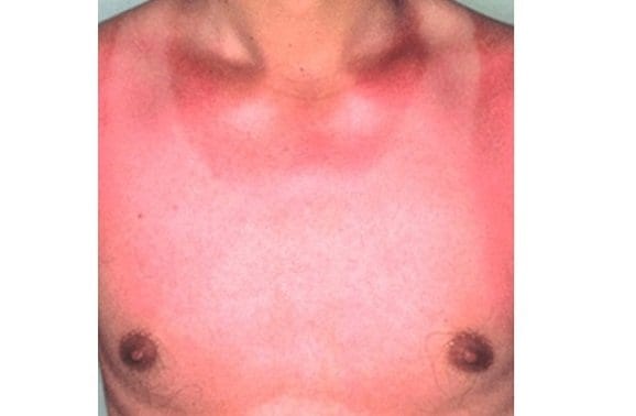 光線過敏症の症例（画像提供：帝京大学皮膚科名誉教授 渡辺晋一氏 田辺三菱製薬（株）「ヒフノコトサイト」より）