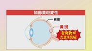 50歳以上は要注意「加齢黄斑変性」　視野がゆがむ、目がかすむ人は早めの受診を　1、2年で急激に進行も