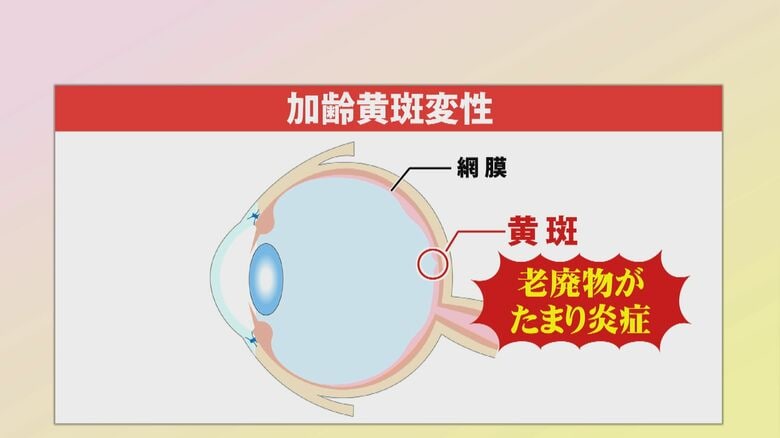 急激に進行する場合も