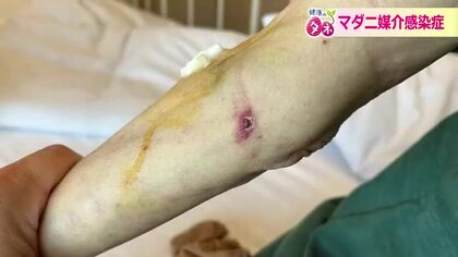 患者数が全国的に増加　マダニが媒介する感染症に注意　ズボンの裾は靴下に！対策と危険性を医師が解説