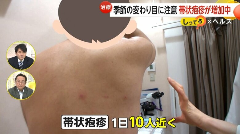 1日10人近くが帯状疱疹で受診している東京八丁堀皮膚科