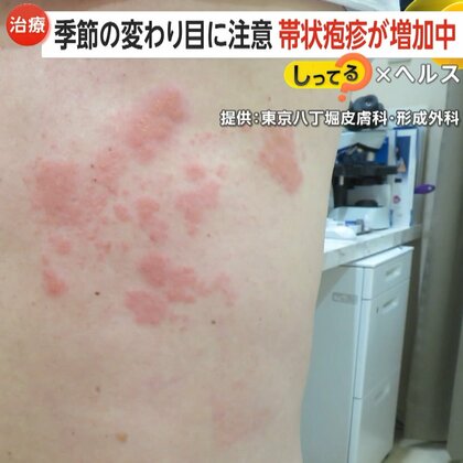 【注意】「痛くて目が覚める」帯状疱疹が20代～40代でも増加中…その要因とは？治療の遅れで神経痛・顔面まひリスクも
