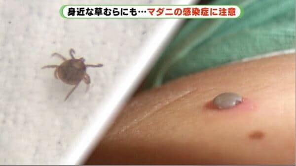 致死率30 草むらに潜む脅威 マダニ感染症 広がる ペットも死亡の危険あり 静岡発