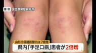 【感染症／山形】手足口病の患者急増105人（前週比+52人）　庄内・山形市保健所管内で警報レベル