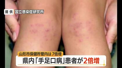 【感染症／山形】手足口病の患者急増105人（前週比+52人）　庄内・山形市保健所管内で警報レベル