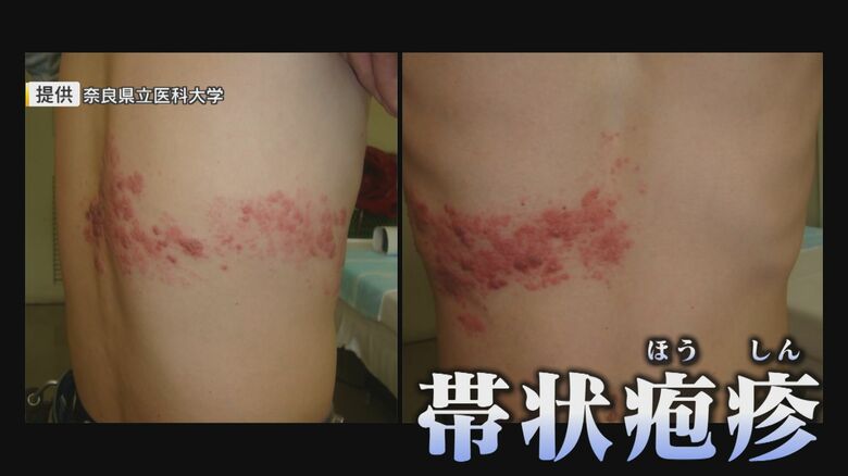 激痛 帯状疱疹 「80歳までに3人に1人が発症」 4月からワクチンの定期接種 任意接種も一部助成へ【福岡発】｜FNNプライムオンライン