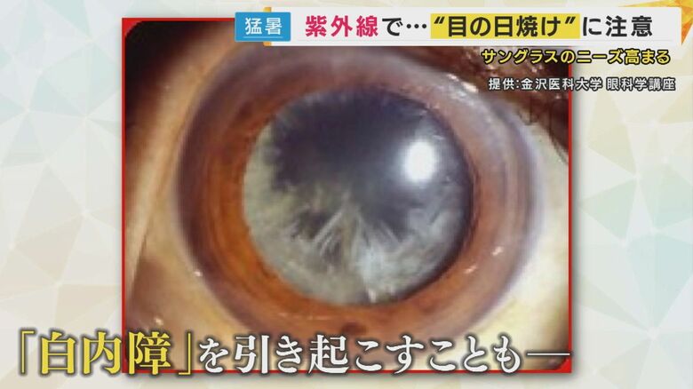 紫外線を浴び続けることで「白内障」を引き起こすことも