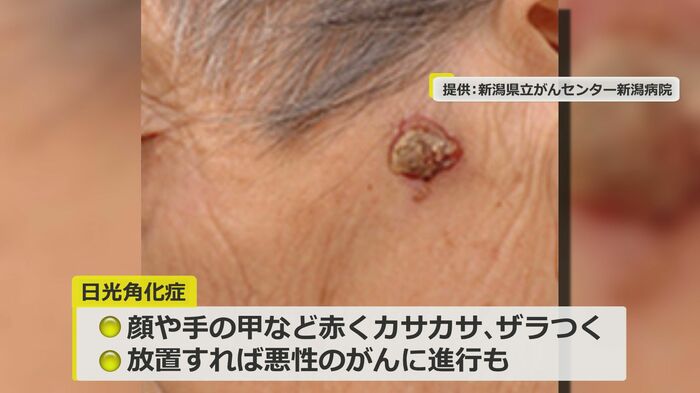 日光角化症