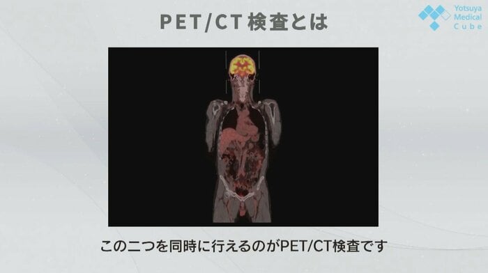 PET/CT検査(提供:四谷メディカルキューブ)