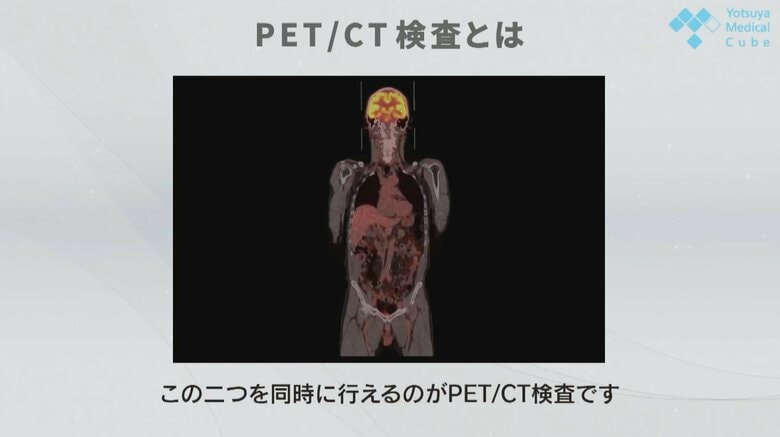 PET/CT検査（提供：四谷メディカルキューブ）