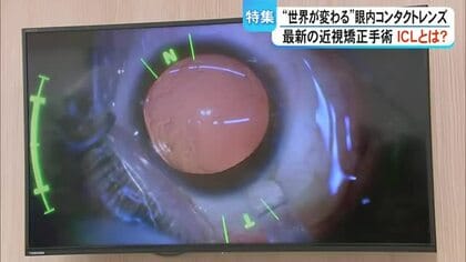 近視矯正手術ＩＣＬとは【熊本】