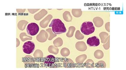 潜伏期間は約50年　白血病や神経難病のリスクとなるウイルス「HTLV-1」　国内は65万人が感染　うち半分は九州に集中　医師は検査の重要性を訴える